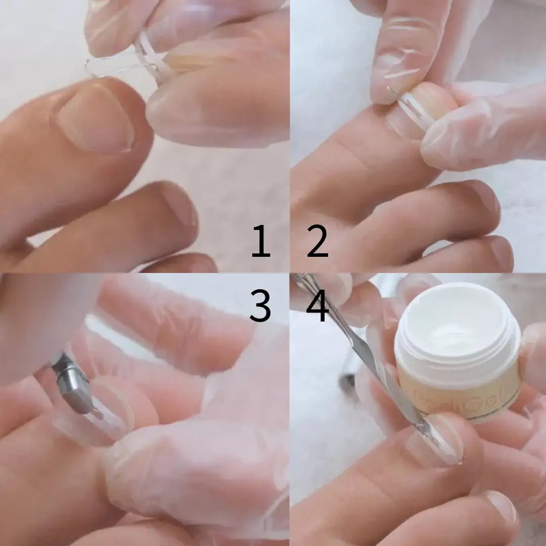 M מידה  PodoFix® Refill - גשר הדבקה אקטיבי לתיקון ציפורניים